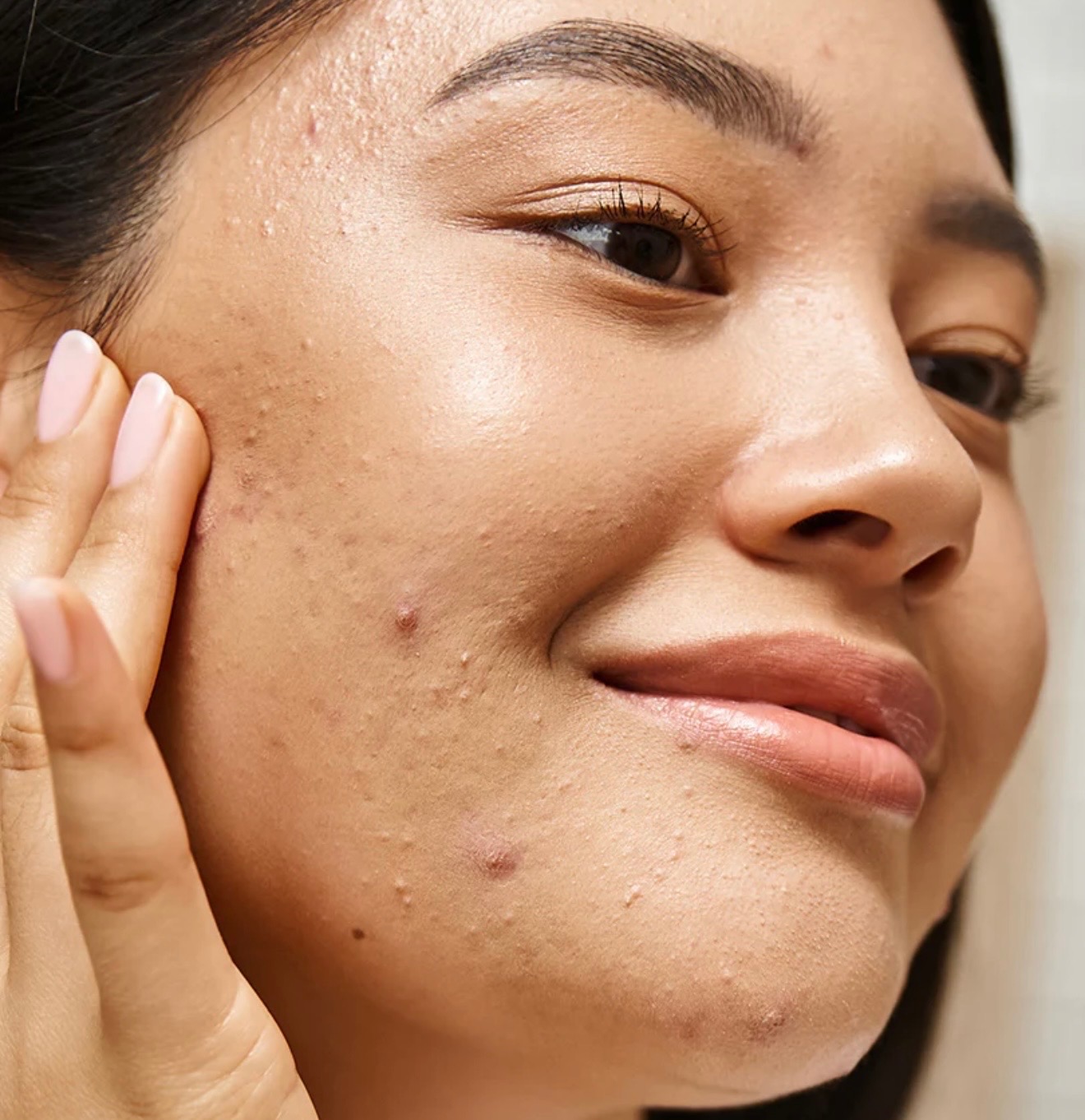 Acne Rescue Facial